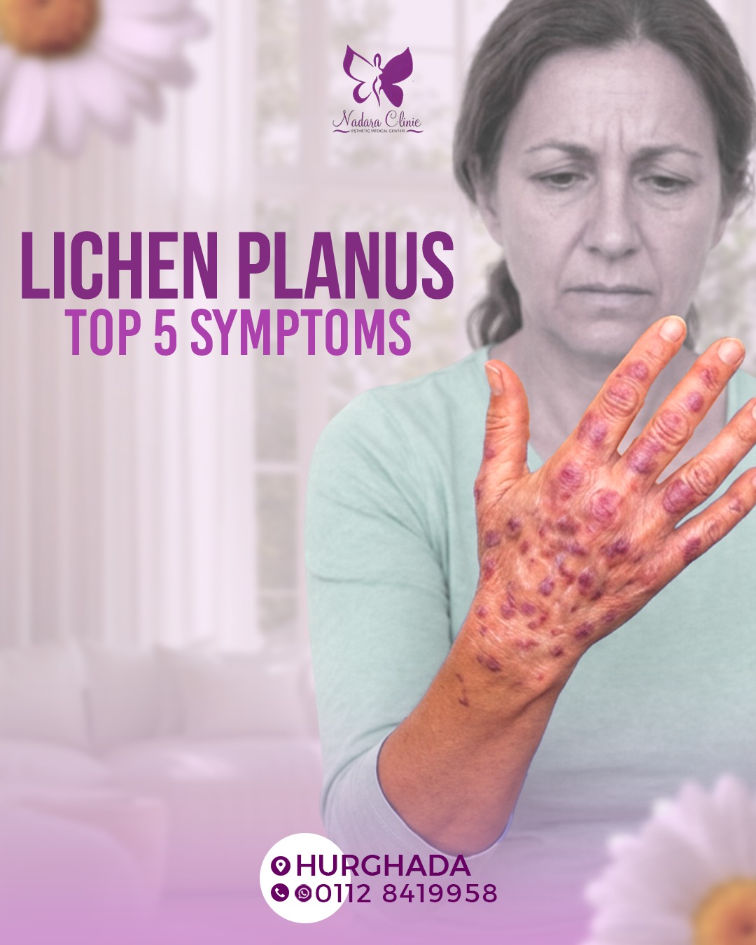 Lichen planus: Top 5 symptoms of infection in Hurghada